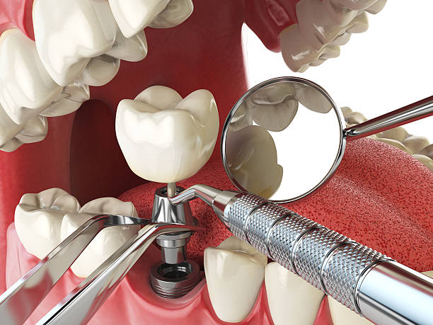 Best Emergency Root Canal Therapy in Manhattan, MT